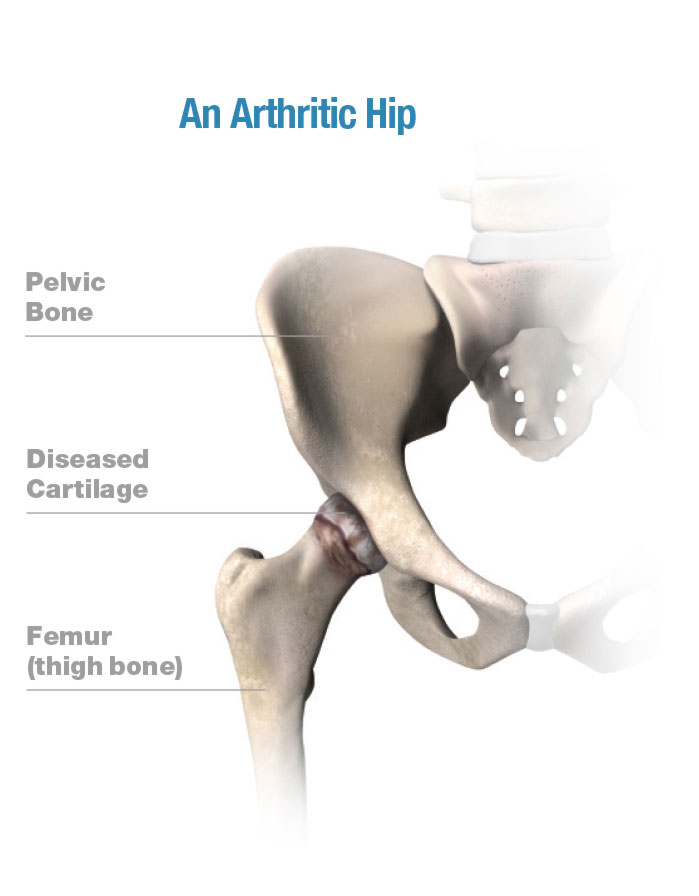 G1 0000 healthy replaced hip left