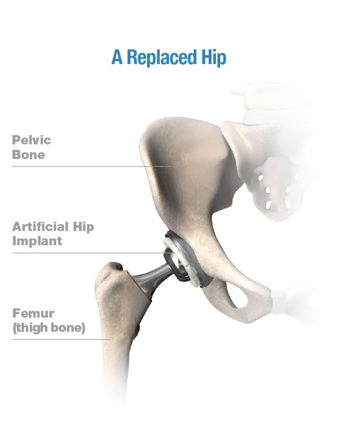 G1 0000 healthy replaced hip right