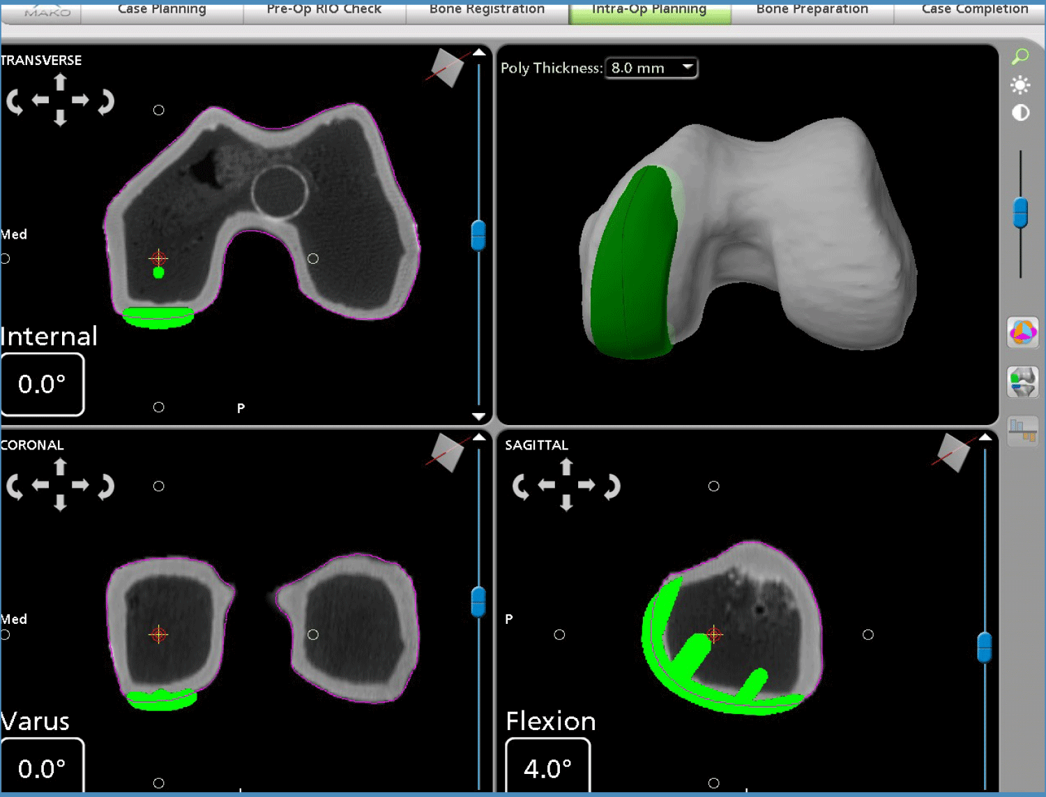 Knee planning