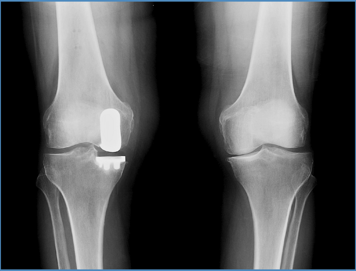 Knee xray