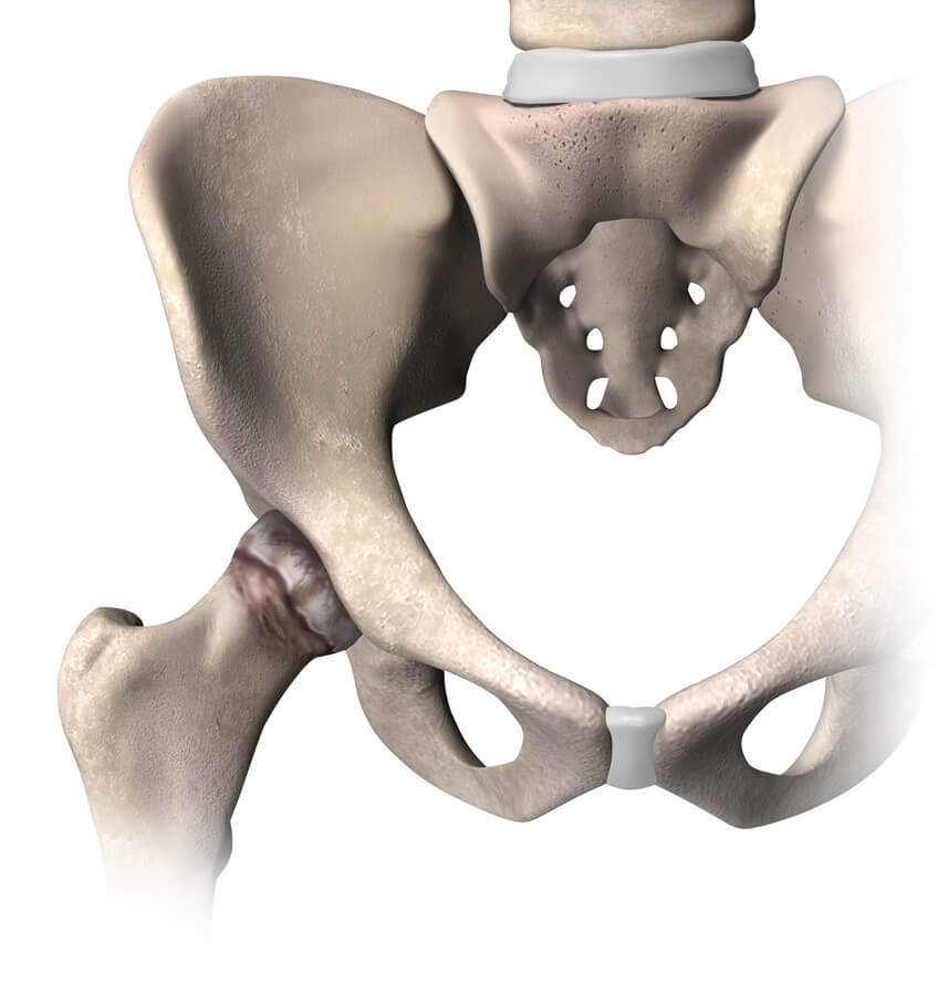 What is hip replacement sidefade