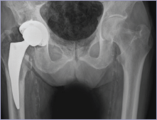 Xrayhip